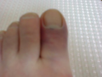 2011.04.20 紫に腫れた親指.jpg